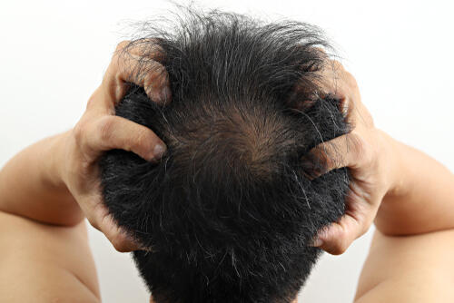 抜け毛の原因は男女で違う！食べ物やアルコールも影響する？