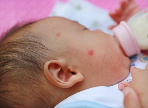 赤ちゃんの虫刺されは悪化しやすい 正しい対処法をご紹介 子育て オリーブオイルをひとまわし