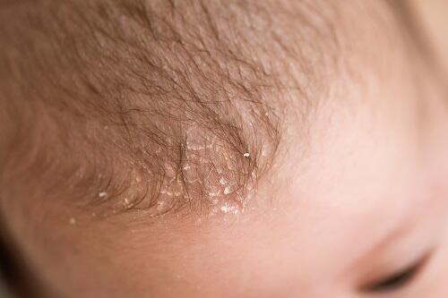 頭皮 フケ 赤ちゃん 頭皮のプロが教える！子供のフケの原因と対策の完全ガイド