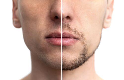 髭を脱毛する前と後の比較写真