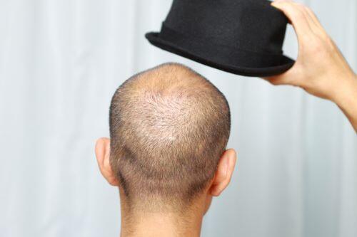 帽子をかぶろうとしている坊主頭の男性の写真