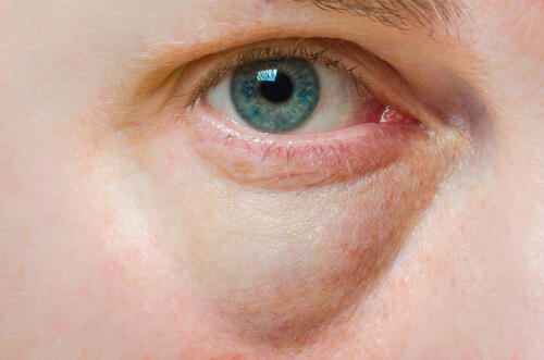 目の下のたるみを取る方法 眼輪筋を鍛えれば改善する 身嗜み オリーブオイルをひとまわし